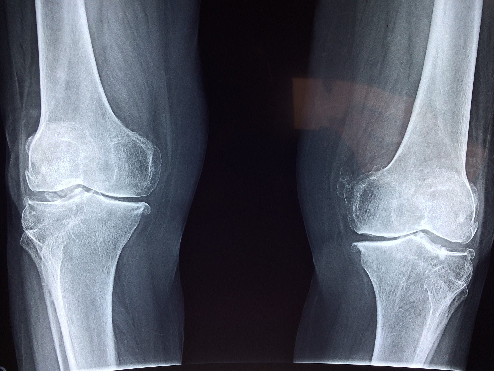 Arthrose du genou : 6.000 pas par jour limite les risques - Sciences et  Avenir